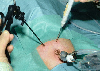 Minimally invasive surgery (MIS)