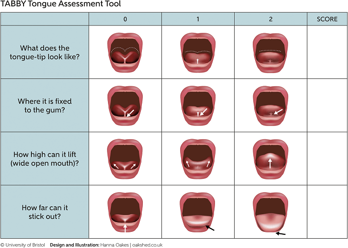 What Is Tongue Tie In Babies & Children - Causes, Symptoms & Treatment ...